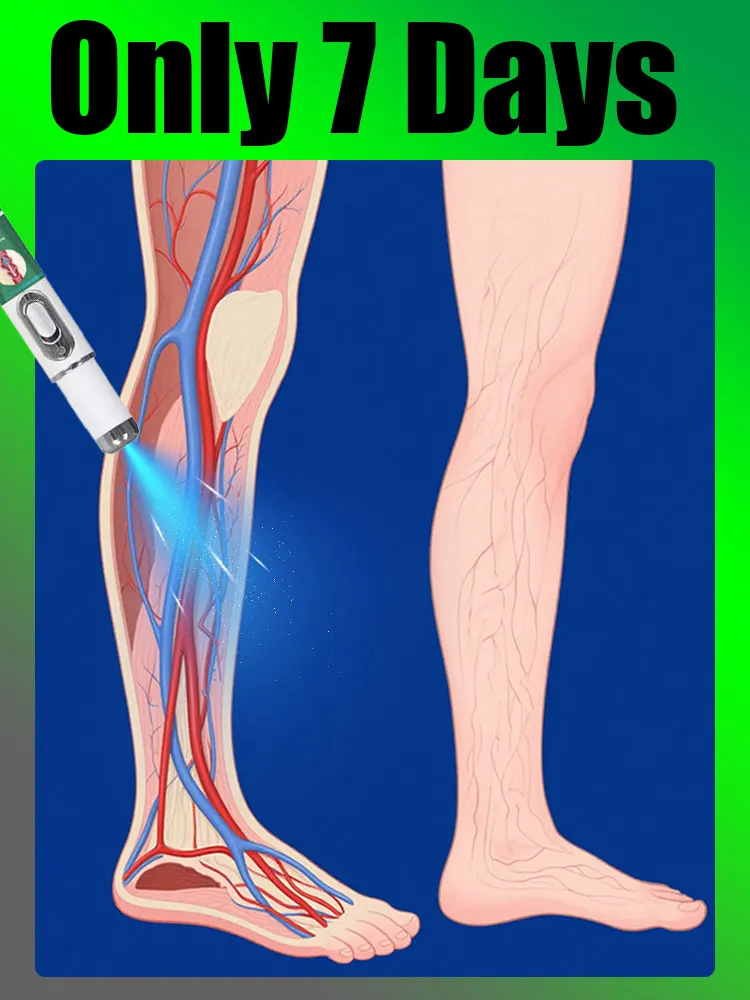 

Быстро устраняет варикозное расширение вен, горячие продажи инструментов для ухода за ногами