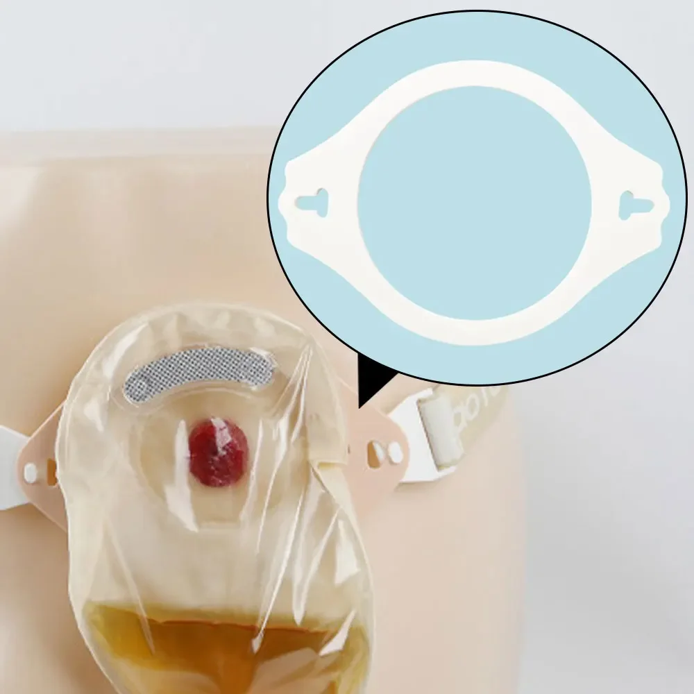 62/72/82/90mm Ostomy Surgery Bag Reinforcement Stoma Leak-Proof Stool Bag Stoma Belt Fixed Ring Buckle Style Accessories