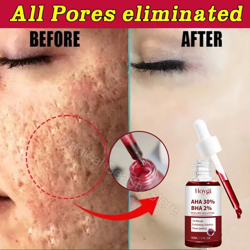 

Salicylic Acid Pores Shrinking Serum Exfoliating Acne Treantment Blackhead Pores Removal Essence Moisturizing Repair Skin Care