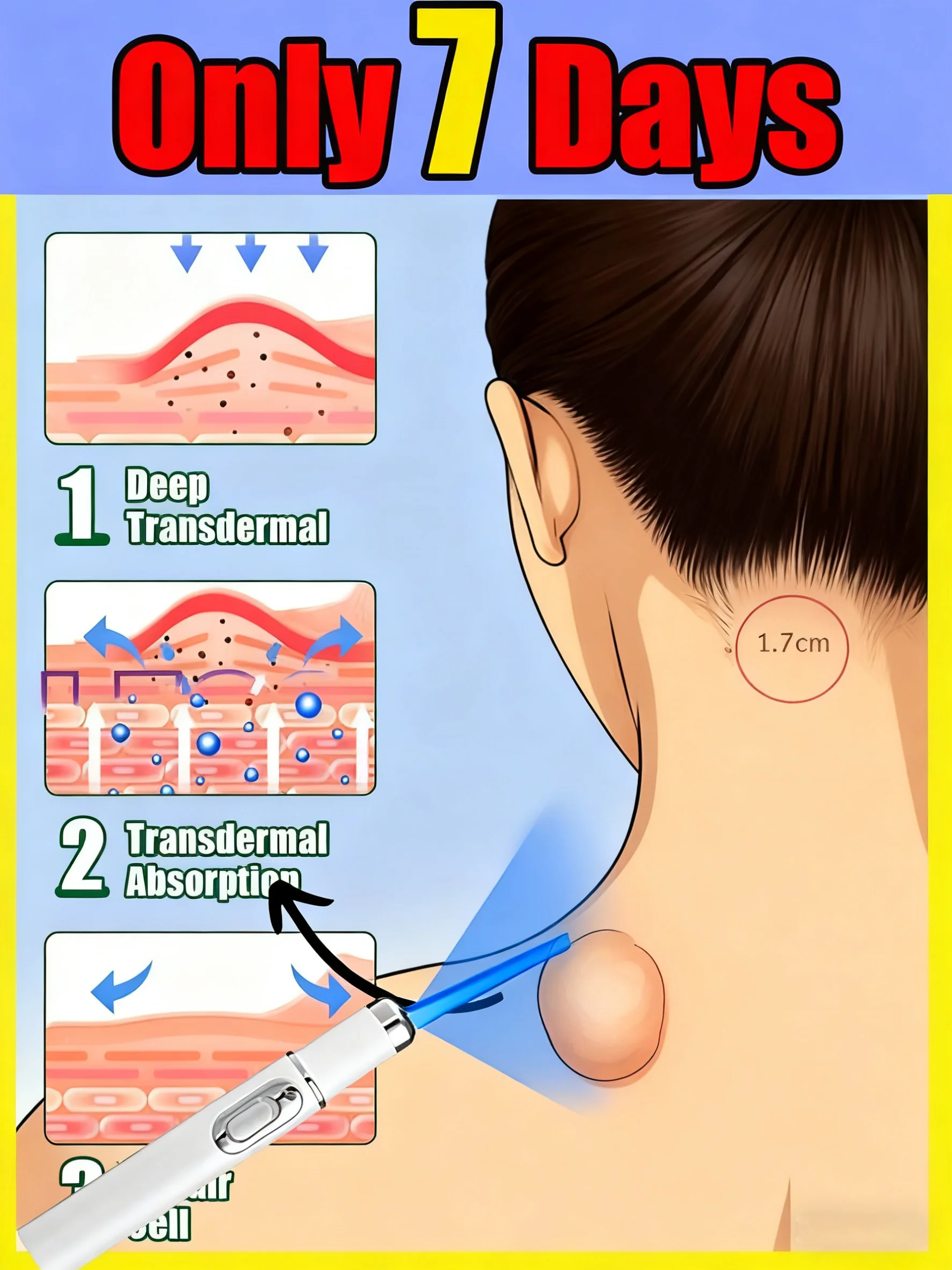 

Лазерная ручка Gentle Blue Light, длительный уход за кожей.