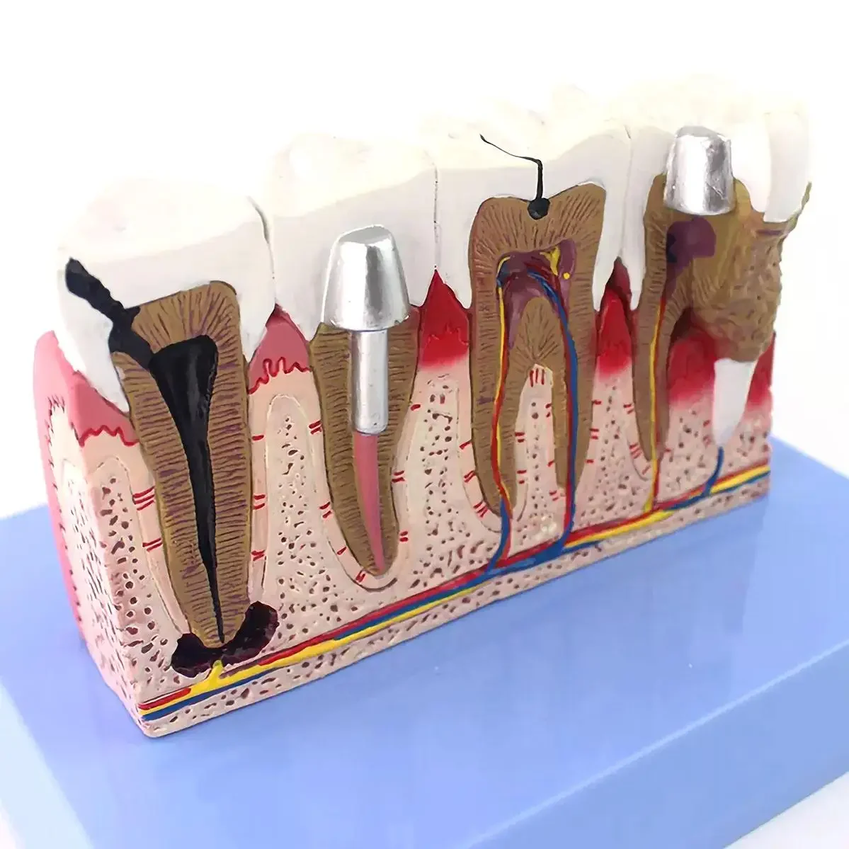 

Модель патологических зубов человека из ПВХ с дентальной картой, медицинские анатомические модели для обучения