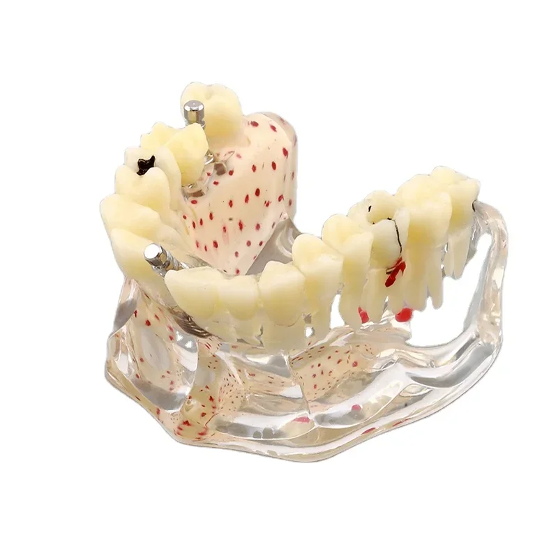 Dentals anatomy model implantation practice model hot sale