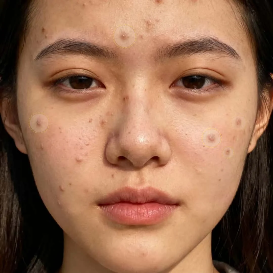 36 patchs hydrocolloïdes contre l'acné – autocollants de boutons invisibles pour un soulagement rapide des imperfections, apaise la peau.