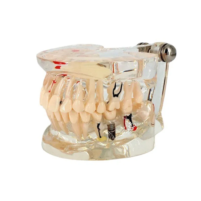 Dental Teeth Model For Studying Education Transparent Tooth Implant Model