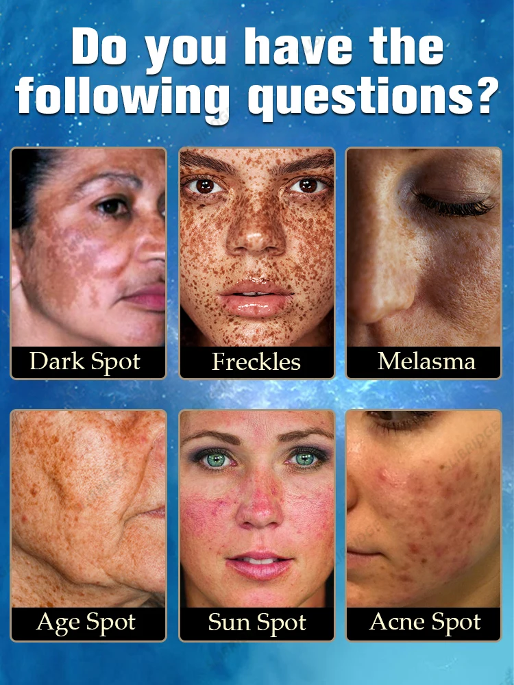 Freckles Melasma Removal Dark Spots Remover For Face