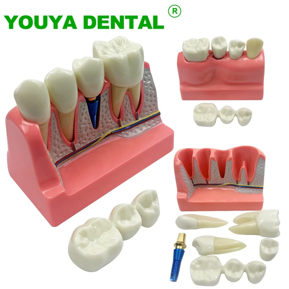 Dental Implant Teeth Model 4 Times Implant Analysis Crown Bridge Removable Model Dentistry Demonstration Tools Dentist Teaching