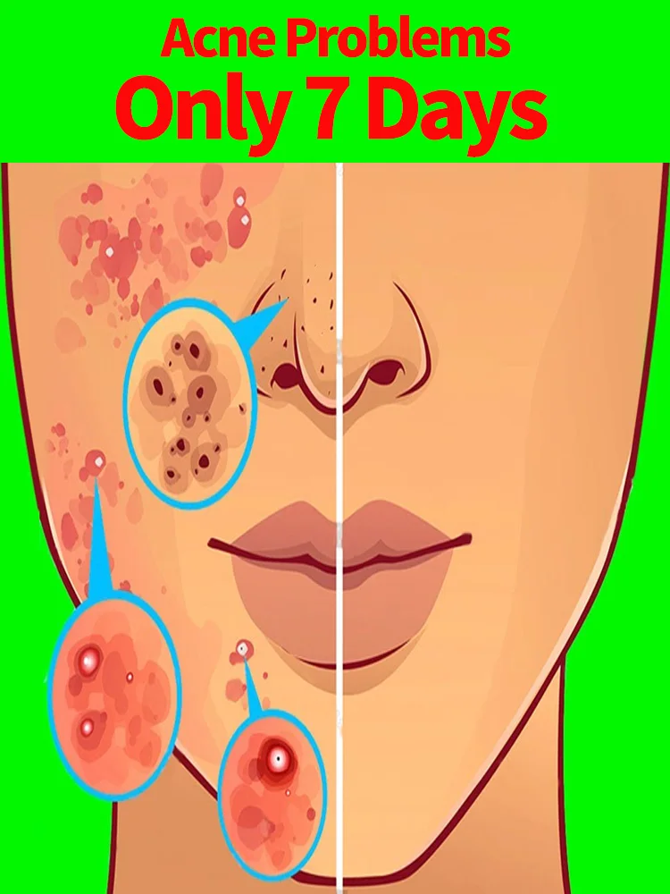 

Moisturizing Skin Remove Acne Marks Deep Cleaning Repairing Acne Spots
