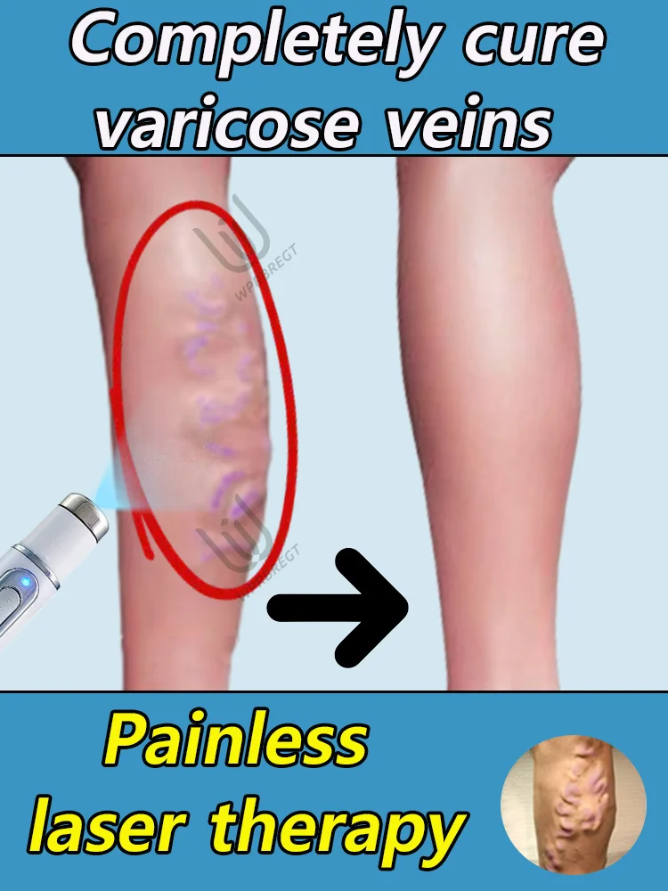 

Spider Legs Varicose Veins Treatment Laser can remove varicose veins painlessly