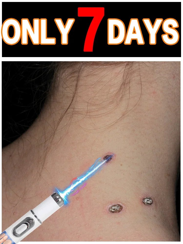

Blue Light Wart Care Laser Pointer Latest Hot Selling Tool for Removing Warts