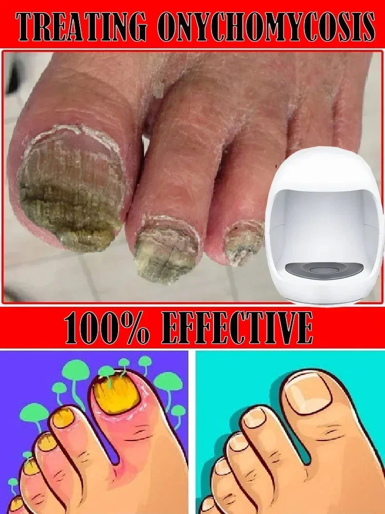 Fungal Nail Laser Onychomycosis Fungus Nails Repair Fast