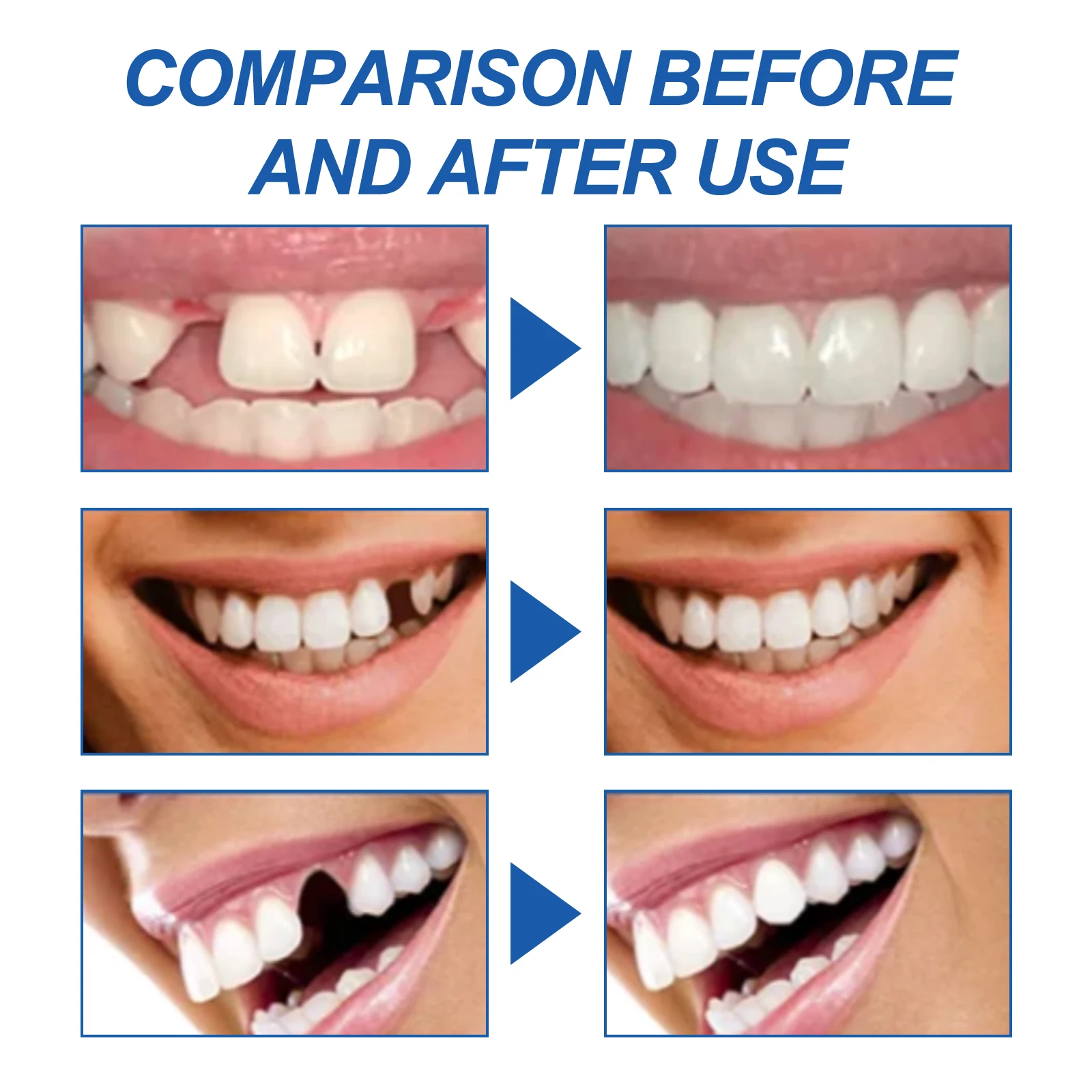 Denti finti modellabili strumenti di riparazione dentale perline di riparazione della protesi per il fissaggio riempimento dente rotto mancante protesi ad alto raccordo