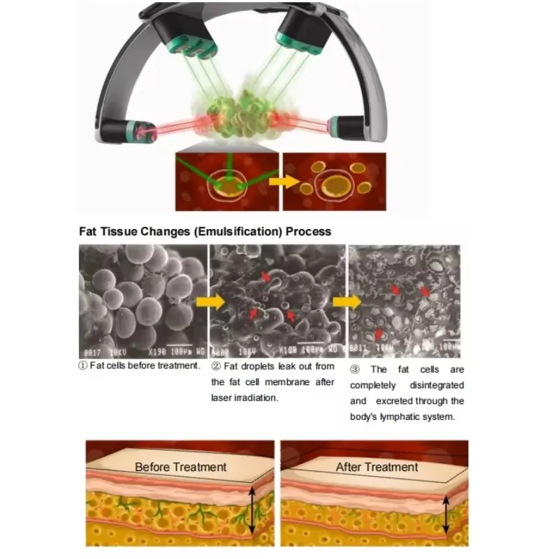 532nm Green 10D Sculpting Fat Removal Green Light Cold 532Nm Burn Fat Body Slimming