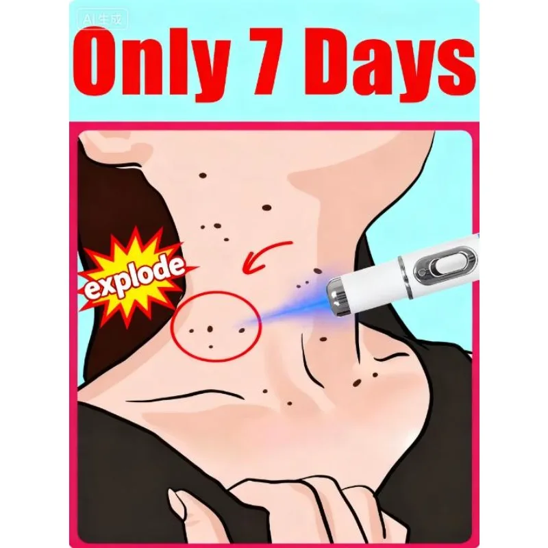 

Newly upgraded blue laser pointer says goodbye to warts