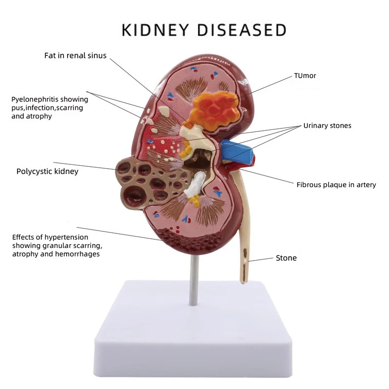 Life Size Kidney Pathologies Model Human Body Anatomy Replica of Diseased Kidney Medical Office Supplies Educational Tool