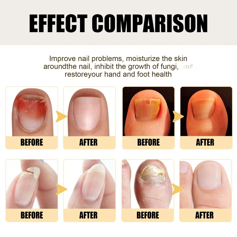 Nail repair essence Fungus Treatment onychomycosis hand care feet fungal removal soft nails thickening brighten Anti infective