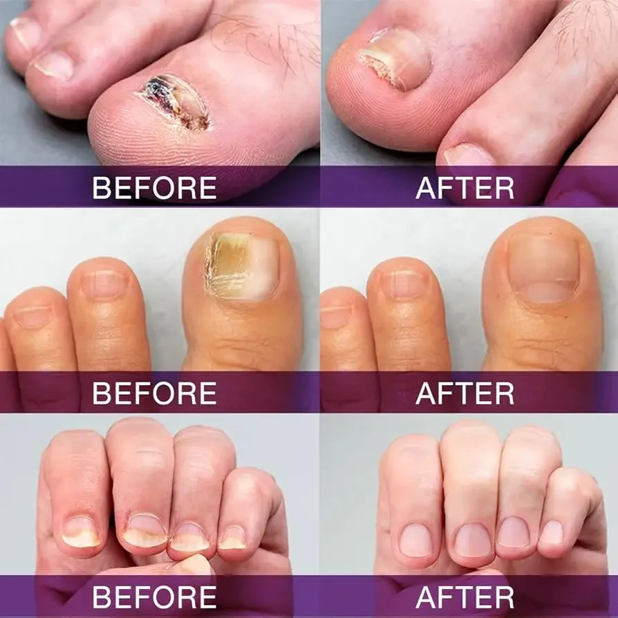 손톱 곰팡이 치료 에센스 손발톱 진균증 제거 손상된 손톱 수리 발가락 감염 방지 젤 발 크림 제거 손톱 곰팡이
