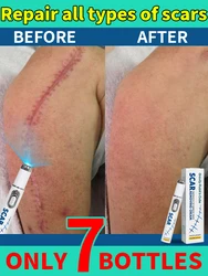 Laser whitening for Repair Scars