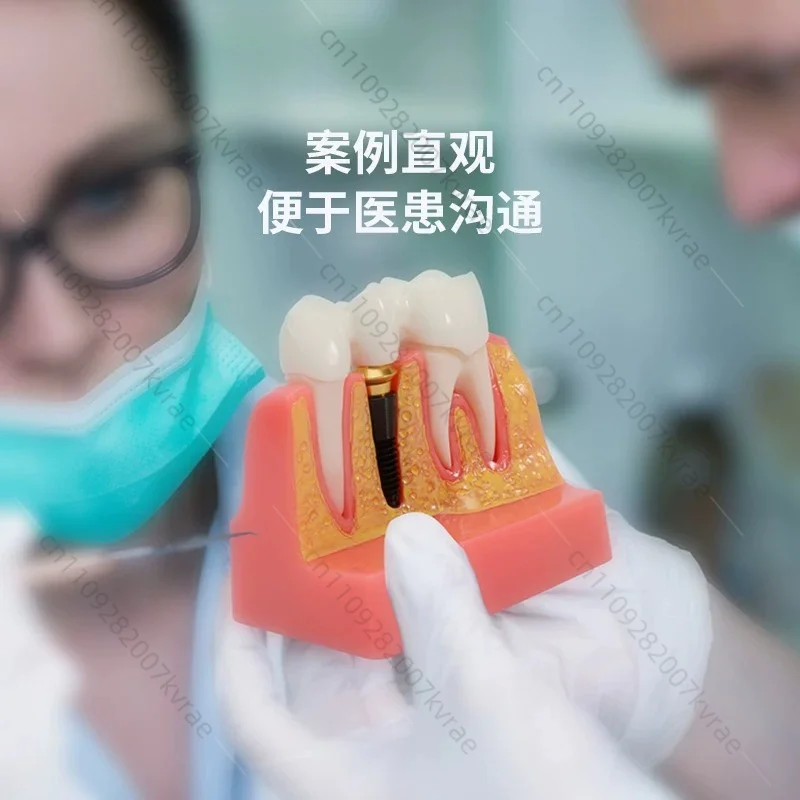 teaching Implant teaching aids Removable  full mouth teeth mold