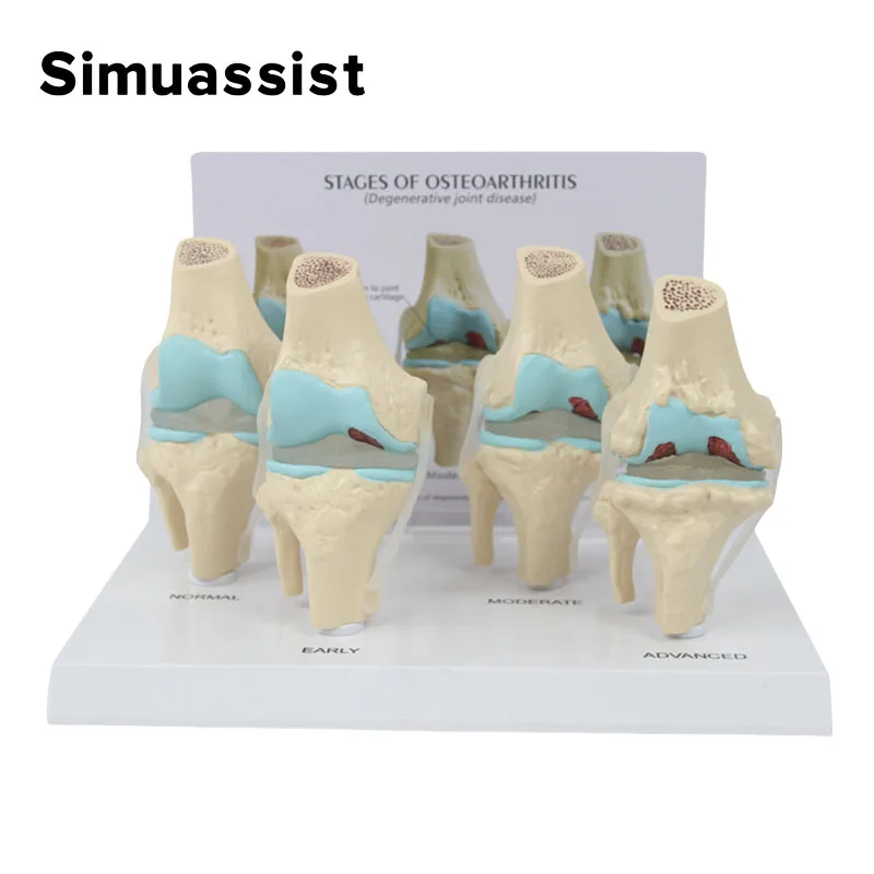 4-stage knee joint model Plastic Bone Model Pathological Knee Model Medical Teaching Model PVC Model