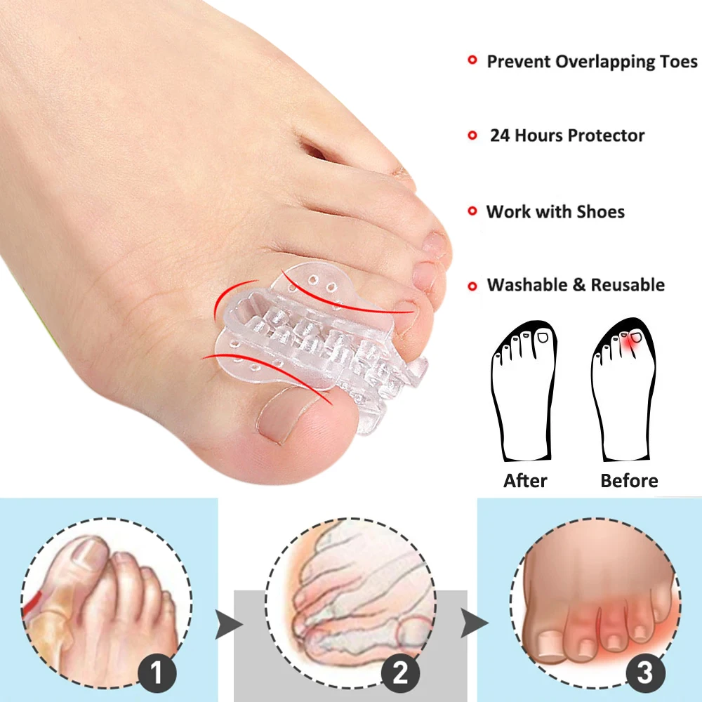 Silicone Toe Separators, Small Toe Separator, Protector for Overlapping Toes, Relief Small Toes, Pressure and Pain, 1Pair