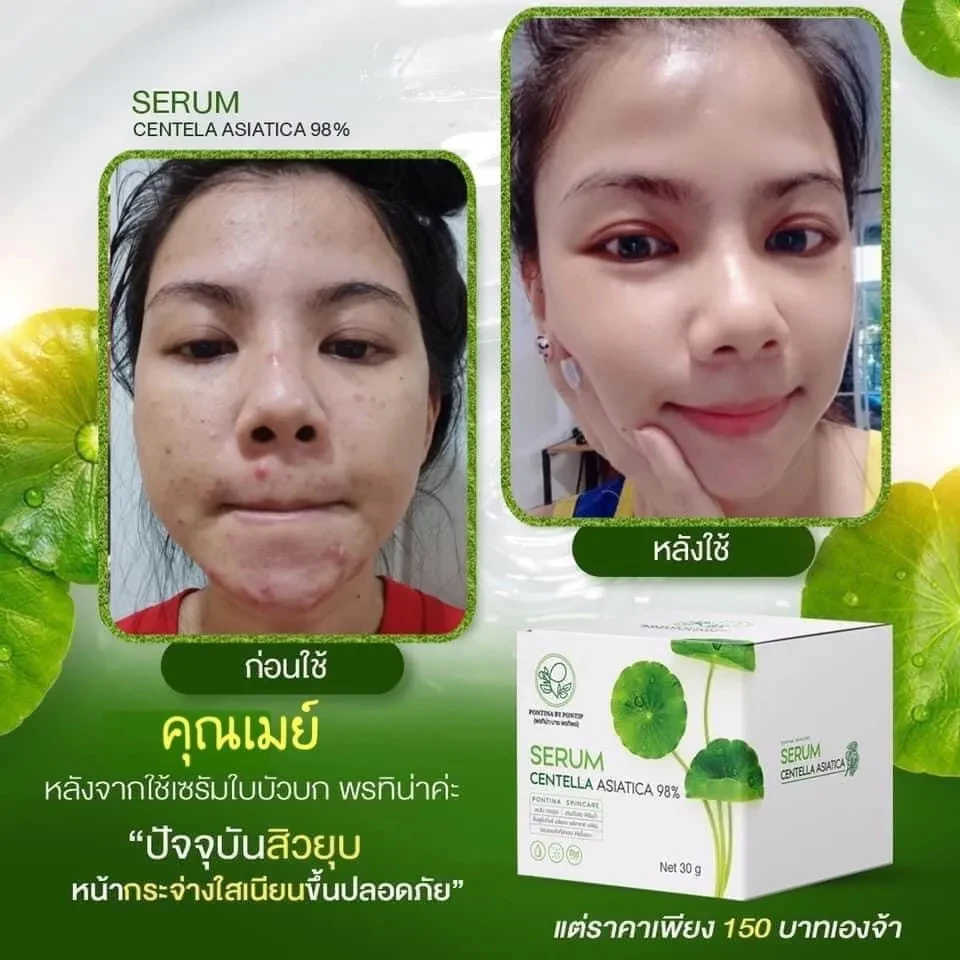 

พรทิน่า เซรั่มใบบัวบก เซรั่มพรทิน่า Pontina Centella Asiatica Reduce Acne Soothes Acne Dries Repair Dark Acne Scars White 30g