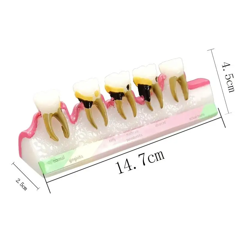 Dental Periodontal Disease Assort Demo Teeth Model 5 Stage Three-Dimensional Proportional Magnification Design for Dentist