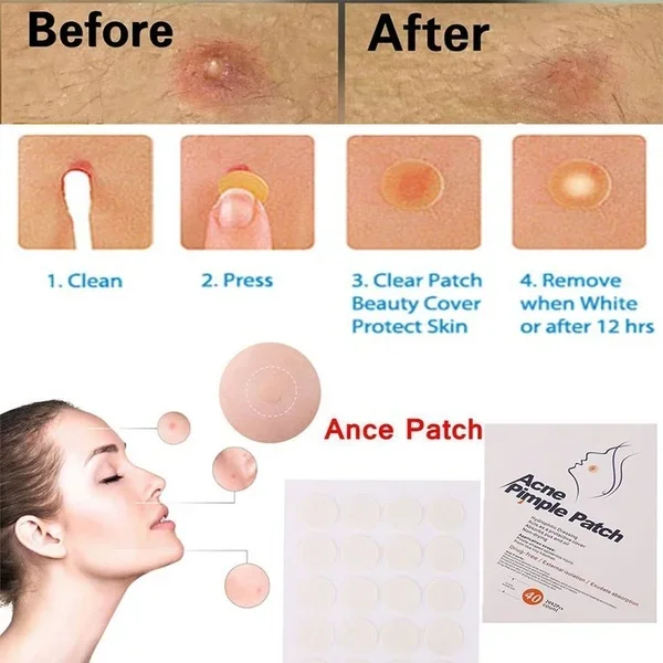 Face Acne Pimple Spot Scar Care Treatment Stickers Facial Skin Care Blackhead Removal Freckle Patches 24pcs/48pcs/72pcs