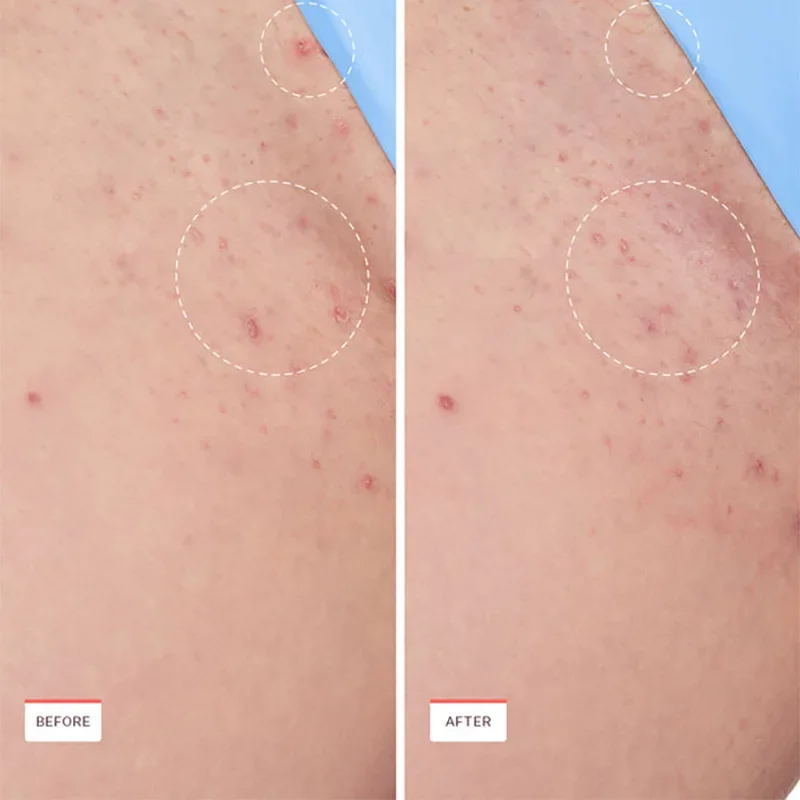 Solusi untuk Esens Bola Penenang Rambut Endogen Anti Rambut Tumbuh ke Dalam di Ketiak dan Bikini