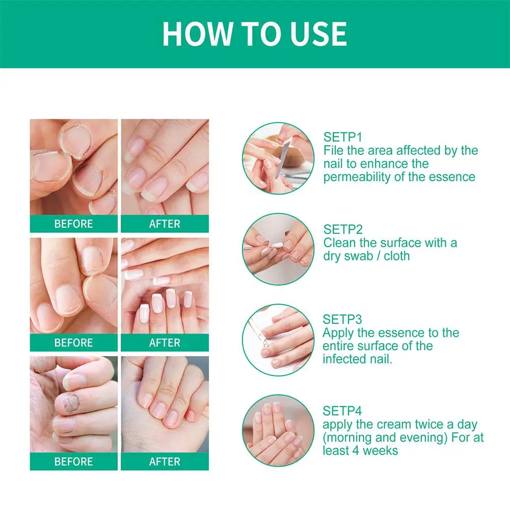 OUHOE 1/3/5PCS Extra Strong Nail Fungus Treatment Serum Essence oil Care Repair Essence Anti Toe Infection Gel Feet Cream