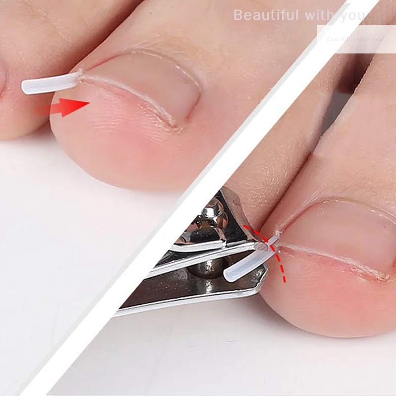 10 peças clipe de alisamento de unha encravada correção de unha adesivo adesivo