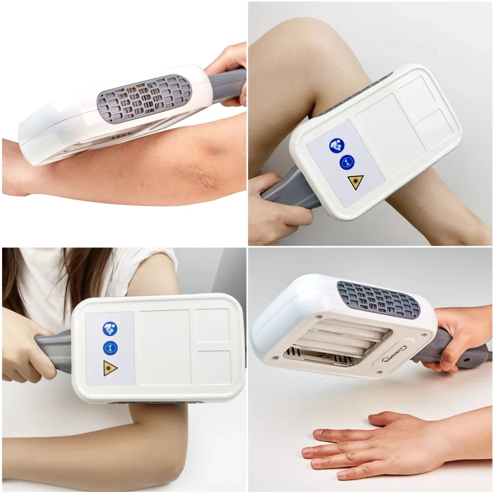 311nm UVB Ultraviolet Light Lamps Wand Class II Online Technical Support for Vitiligo Psoriasis Eczema Skin Disease Treatment