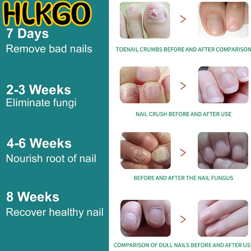 

Fast-Acting Nail Fungus Laser, 407-910nm Intensive Toenail Therapy, USB Rechargeable Fungus Removal Machine