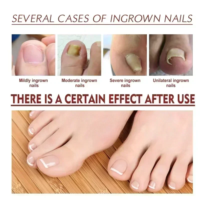 Nail Fungus Liquid Feet Care Essence Nail Foot Repair Toe Nail Fungal Removal Gel New