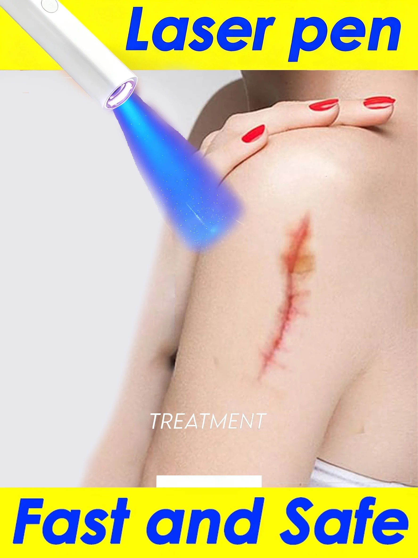 

Newly upgraded blue light laser pen, easy to remove scars