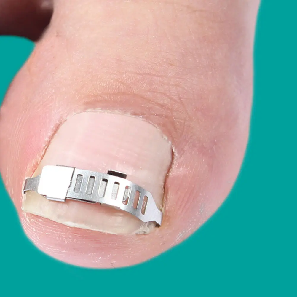 

1 set 1 Set Curved Corrector Tool For Ingrown Toenail Toenail Orthopedic Pedicure Nail Tools Care Tool Nail Inlay Brace