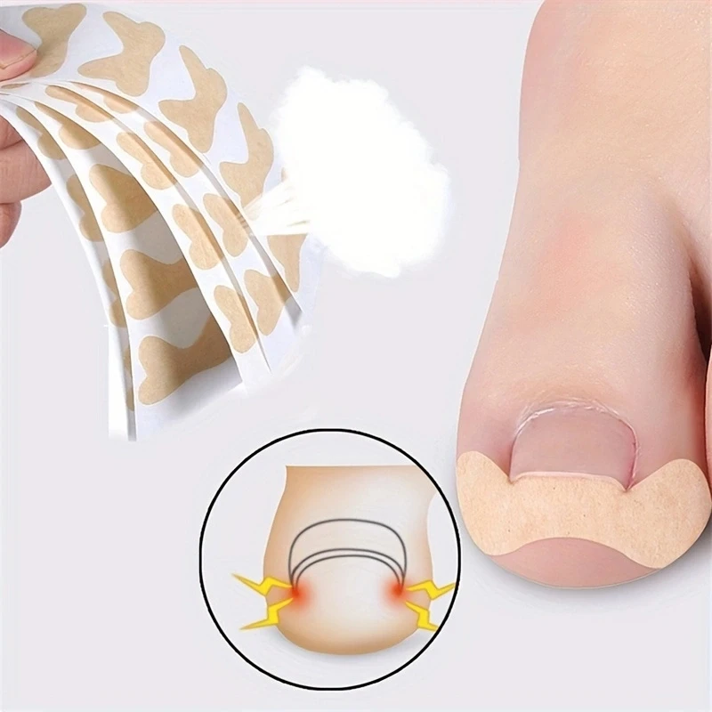 แผ่นแปะเล็บเท้า Ortho แบบไม่มีกาวช่วยปรับปรุงการซ่อมแซมเล็บเท้าที่คุดและช่วยลดการแก้ไขการพับเล็บ