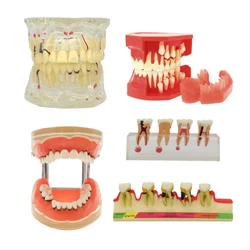 Stomatologiczne patologiczne Model zębów typodontów periodontyki Implant endodontyczne leczenie próchnicy Typodont Model dorosłych dzieci zęby