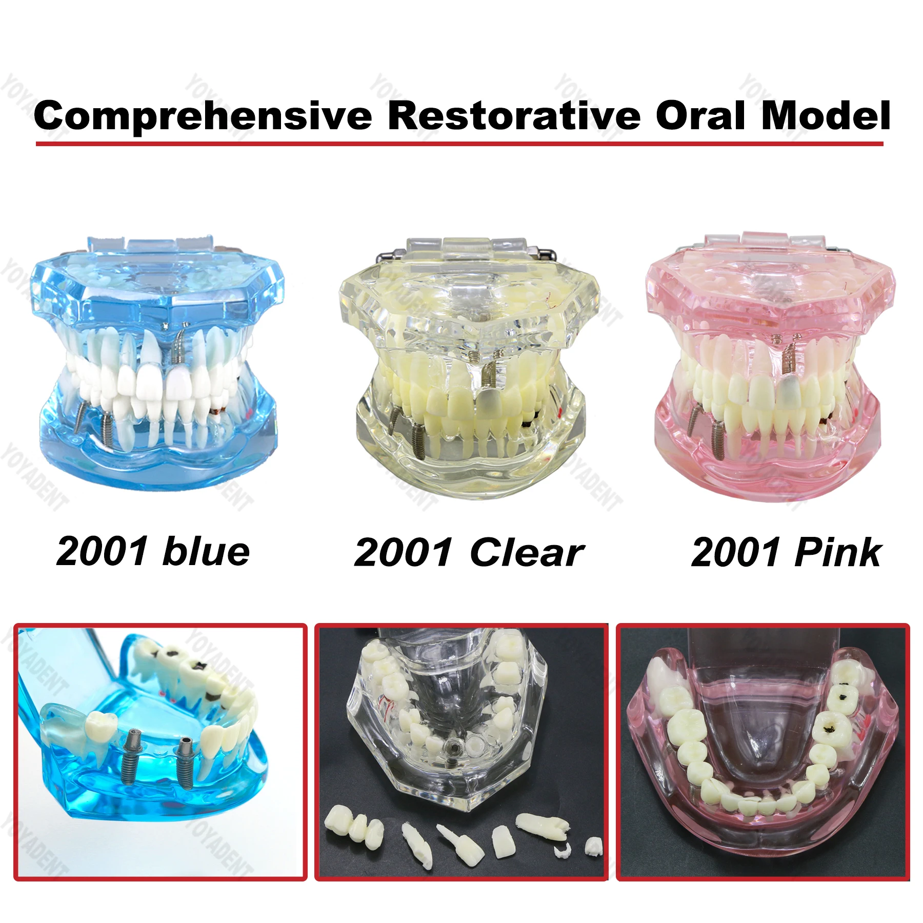 

Dental Model Implant Teeth Resins Model With Restoration Bridge Teaching Model For Patient Education Demo Dentistry Products