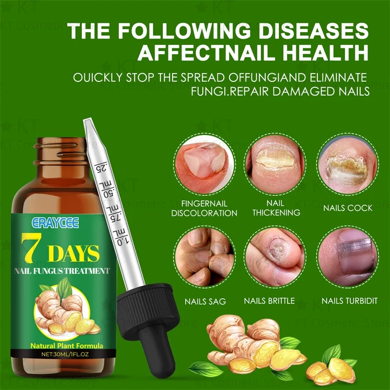 7 日間真菌爪治療血清足の爪真菌除去修復ジェル抗感染爪周囲炎爪真菌症足の爪ケア