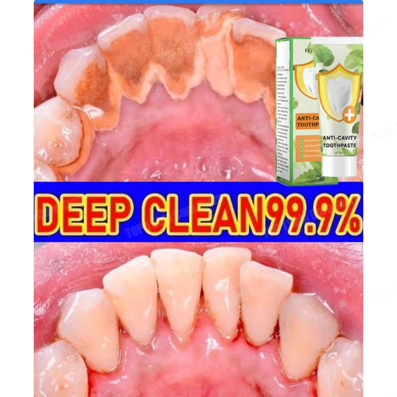 

Teeth cleaning and whitening Teethstains and calculus Plaque PeriodontitisRemove Cavities