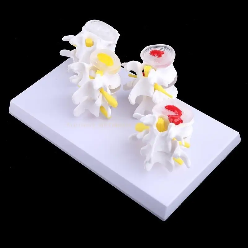 1 Set Human Lumbar Lesion Spine Statue Display Model Medical Teaching Learning f