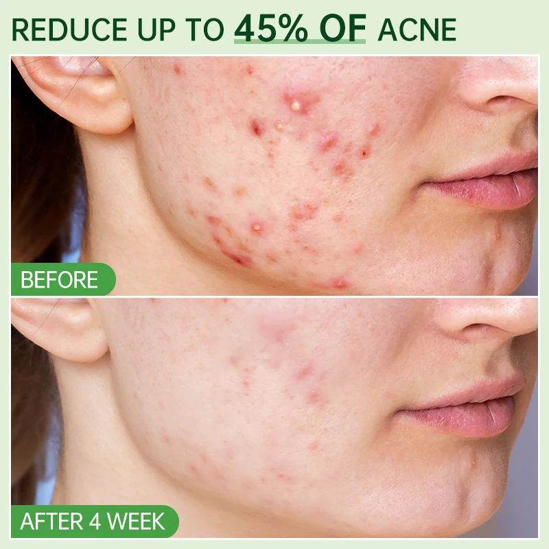 Salicylic Acid Acne Removal Serum Repair Acne Oil Control Shrink Pore Remove Blackheads Face Cleaning Fade Acne Marks Whitening