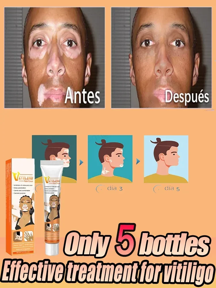 ⁿⁱᶜᵉ Vitiligo Repair Get Rid Of Ringworm White Spots Get Rid Of Skin Vitiligo Eliminate Vitiligo Better Body Skin