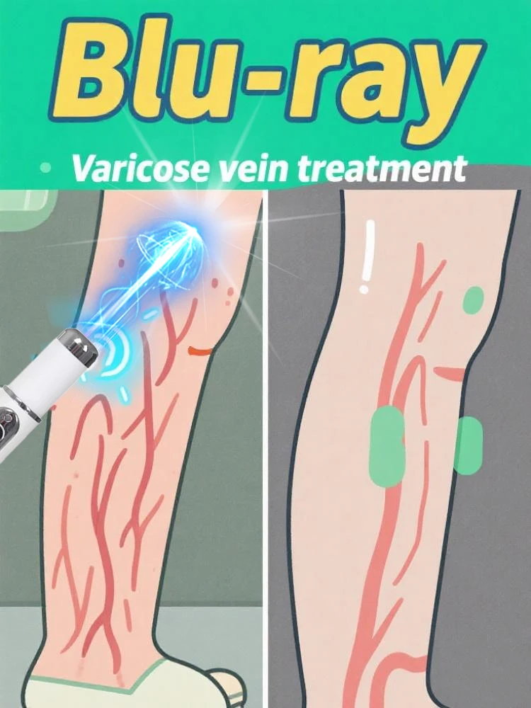 

Самый продаваемый лазерный комплект с синей ручкой защищает ноги