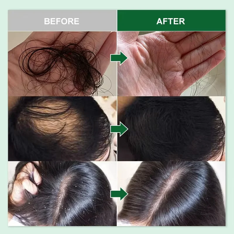 Ginger Hair Growth Serum สบู่ Regrowth Hair Repair Hair Nourish Root Anti Hair Loss Treatment ผลิตภัณฑ์สําหรับผู้ชายผู้หญิง Hair Care