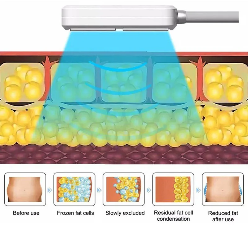 Ems mesin Cryolipolysis pelangsing tubuh portabel, perangkat Salon pembekuan lemak Keren plat Cryo terbaru