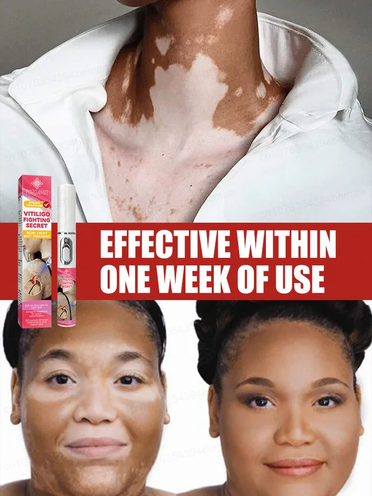 

No need to go to the hospital! Take a photo at home and ᵗʰᵉ ʷʰⁱᵗᵉ ˢᵖᵒᵗˢ ʷⁱˡˡ ᵍʳᵃᵈᵘᵃˡˡʸ ʳᵉᵗᵘʳⁿ ᵗ