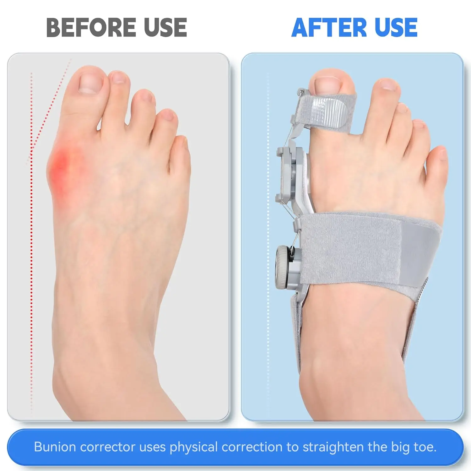 IDEABEL Bunion Corrector Foot Hallux Valgus Braces Rotatable Toe Separator Straightener Adjustable Pedicure Finger Toe Corrector