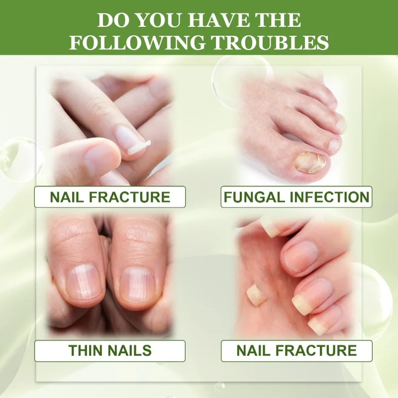 7DAYS Nail Fungus Treatment Liquid Serum Anti-Infection Onychomycosis Paronychia Hand Care Nails Foot Fungal Removal Gel 20ml