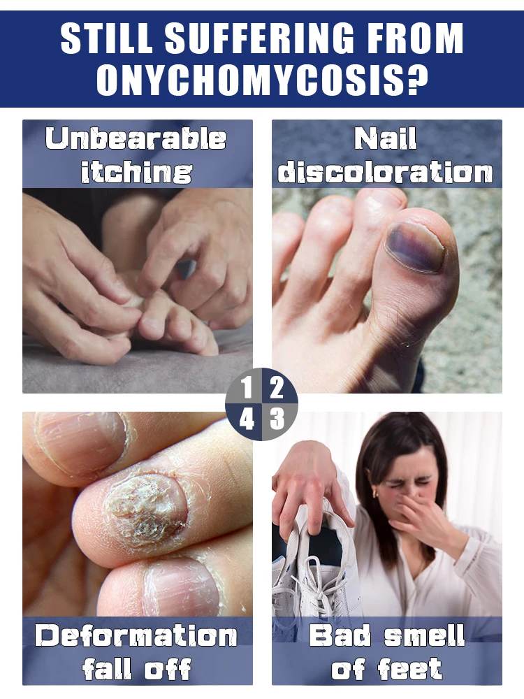 Fungal Nail Repair Fast Onychomycosis Fungus Nails